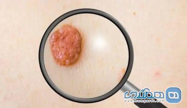 ازبین بردن خال های عظیم با روش های طبیعی